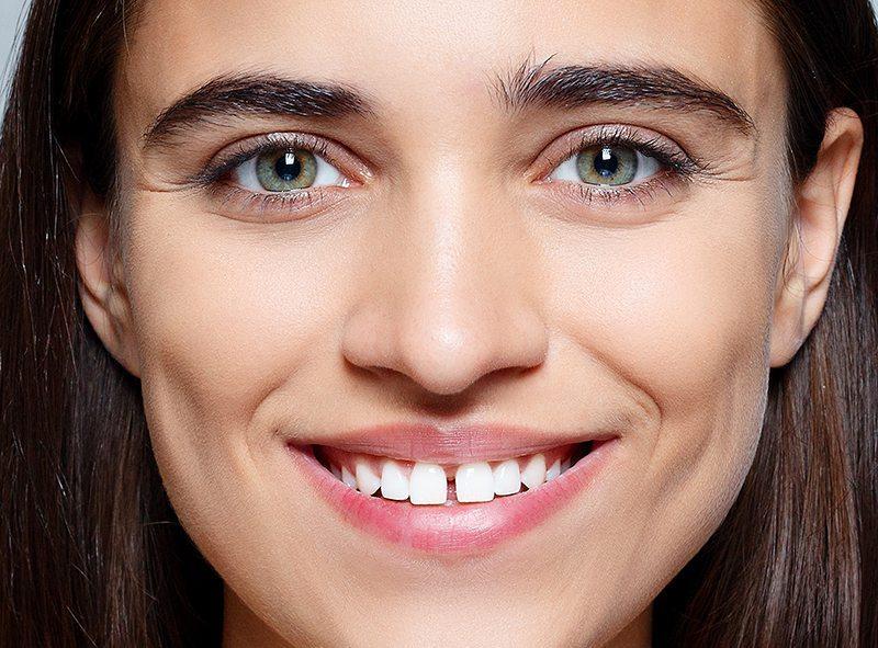 Fixing gaps between teeth - at home clear aligners | NewSmile