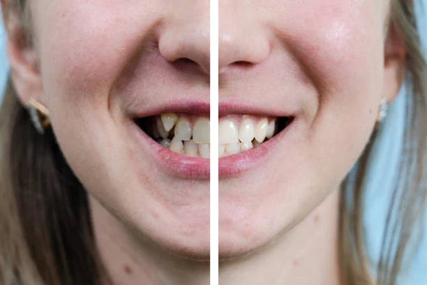 How To Clean Retainers | Step-By-Step Guide & Best Products - NewSmile UK